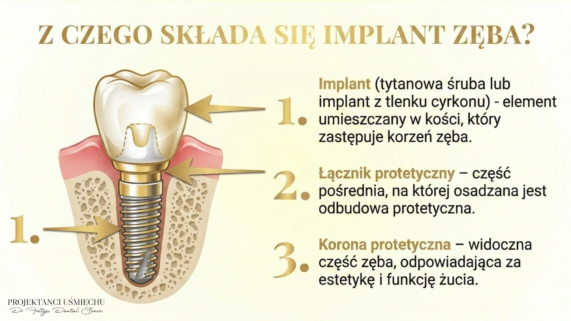 Z czego składa się implant zęba?