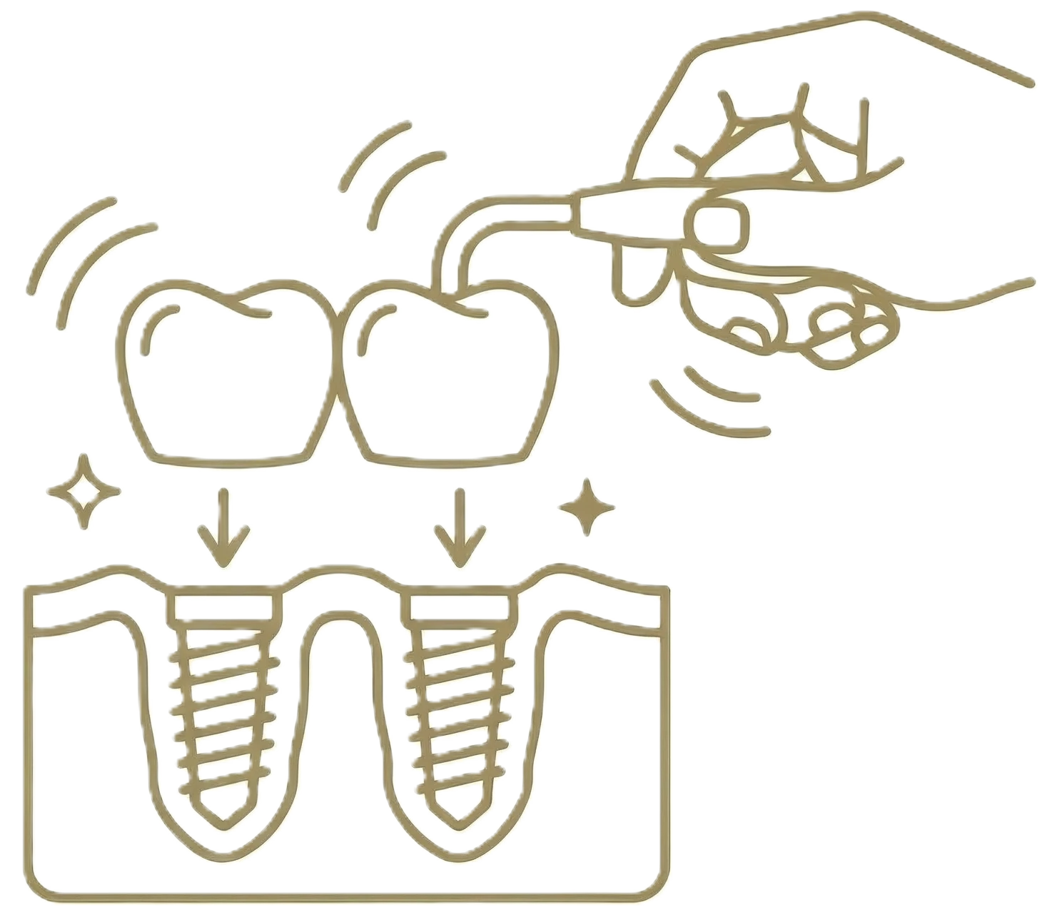 most-protetyczny-na-implantach