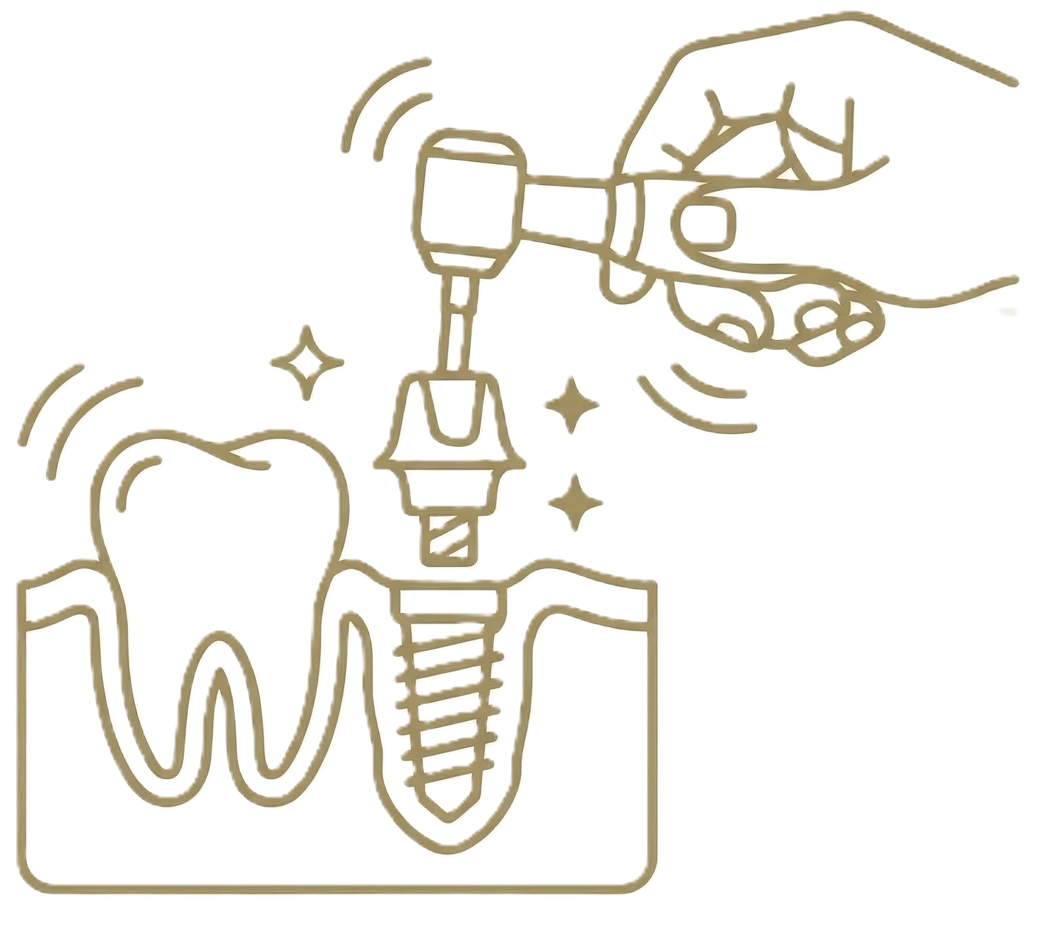 wszczepinie-implantow-zebowych